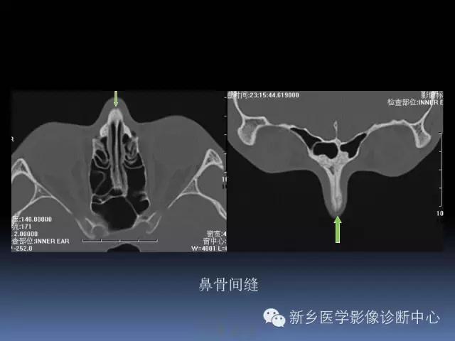 鼻骨骨折在ct片上的表现,鼻骨骨折ct怎么看