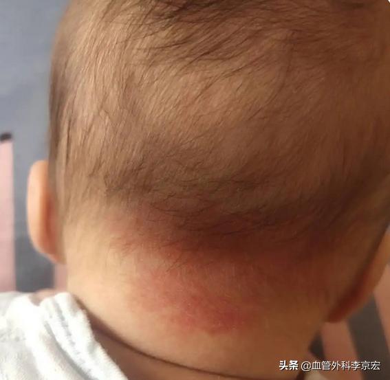 孩子妈妈身上出现小红点要警惕,新生宝宝眼尖红怎么回事