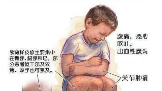 儿童过敏性紫癜尿潜血多久消失,儿童过敏性紫癜痊愈后尿潜血反复