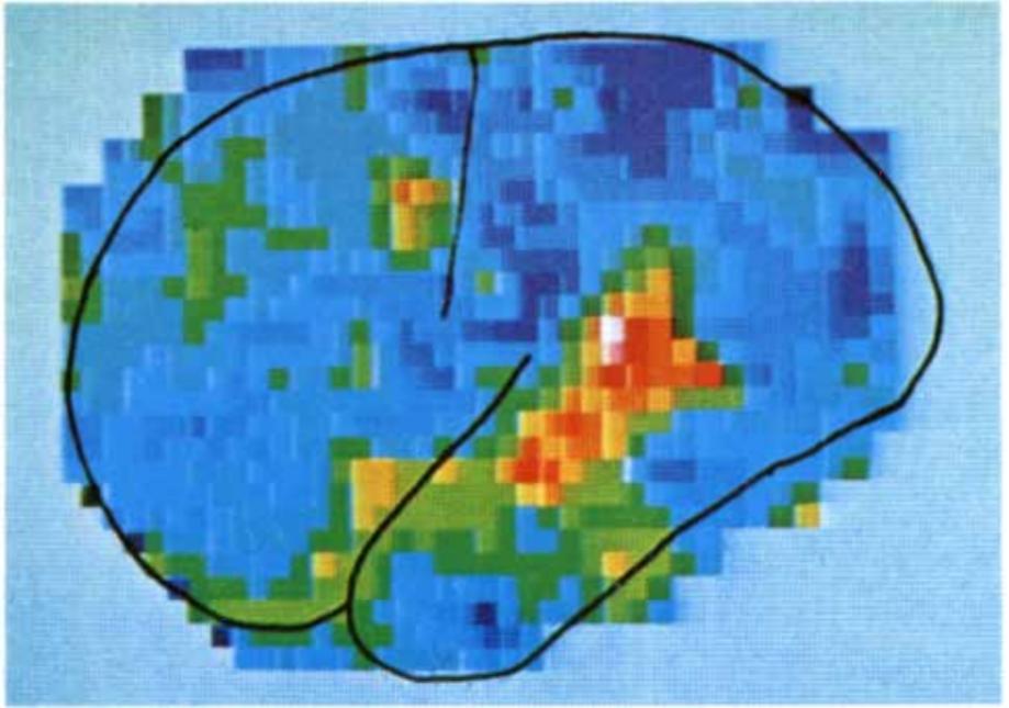 脑功能成像和血管成像,核磁共振脑成像mra是查什么的