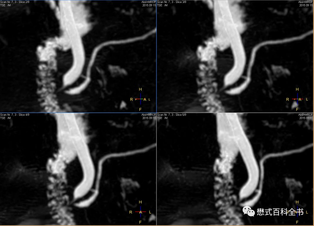 开展mrcp技术,mrcp检查操作流程