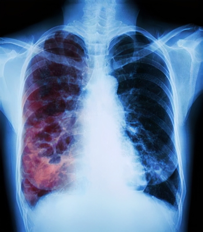 咳嗽半个月去医院做ct确诊肺结核,怀疑得了肺结核去哪里就诊