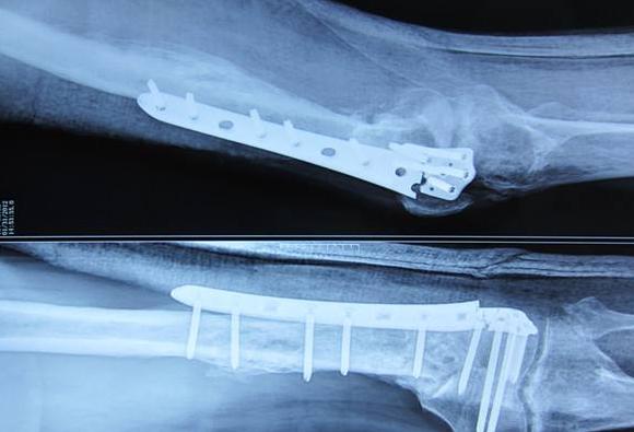 骨折不愈合的有效治疗方法是,骨折不愈合的治疗方法相关文献