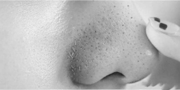 教你科学去黑头从此告别草莓鼻,去黑头的最好方法神器