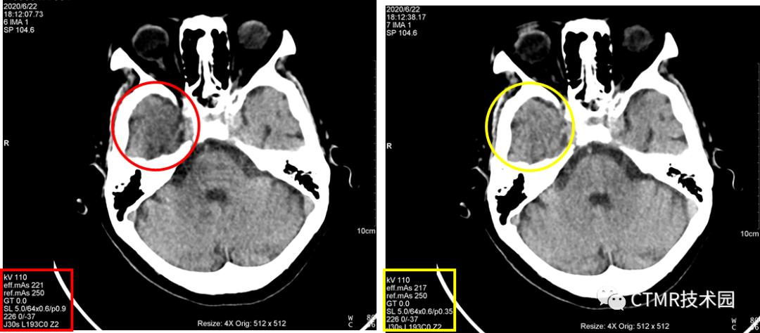 CT影像技术,脑部做ct有伪影是怎么回事