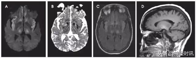 脑卒中的快速识别ppt,脑卒中神经影像学实例解析