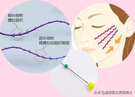 面部除皱用什么方法效果最好,目前面部除皱最安全有效的方法