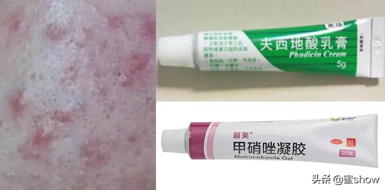 皮肤问题控油缓解长痘,解决皮肤痘痘问题