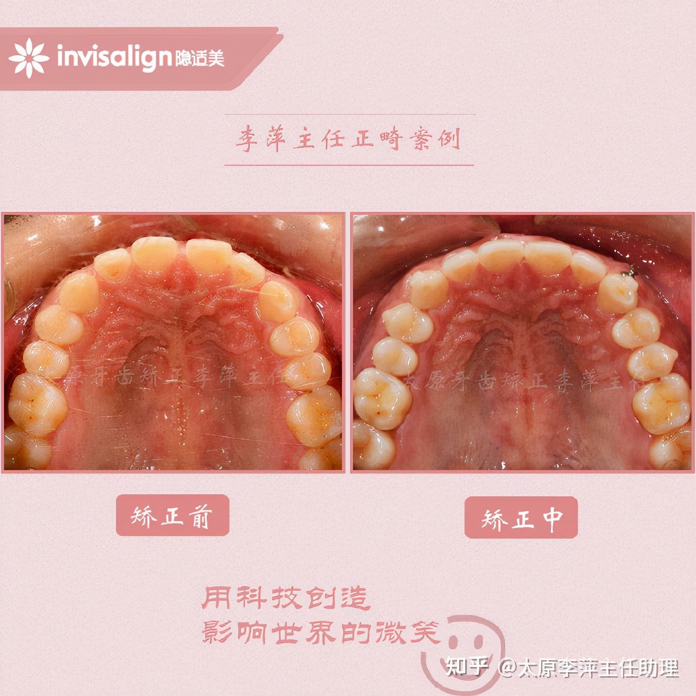太原牙齿矫正靠谱吗,太原成人隐形牙套牙齿不齐