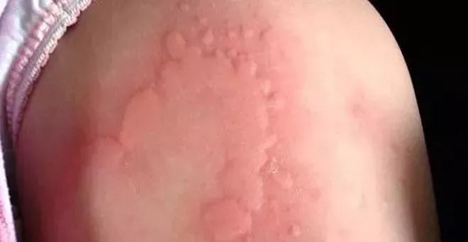 被蚊子咬了是直接拍死还是赶走,被蚊子咬后该干什么