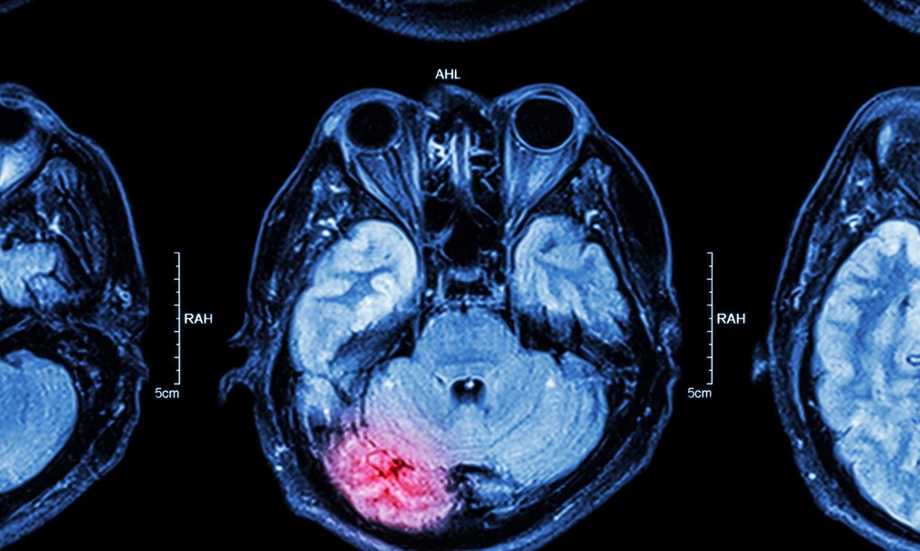 肿瘤来源于皮肤附属器是什么意思,皮肤附属器源性肿瘤能治好吗