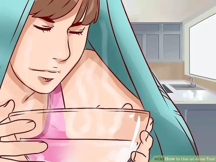 针清祛痘一般多少钱一次,针清祛痘后可以涂甲硝唑吗