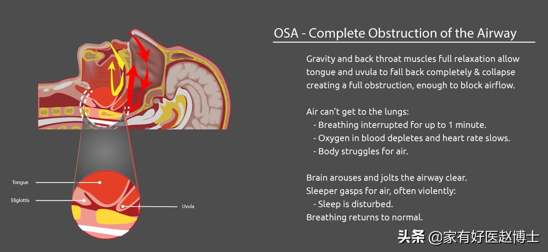 睡眠打鼾的危害科普,打鼾危险性