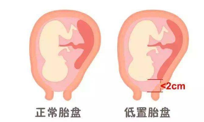 低置胎盘和前置胎盘有什么区别,胎盘低置和帆状胎盘怎么顺产