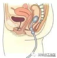 直肠测压,肛门直肠测压治疗