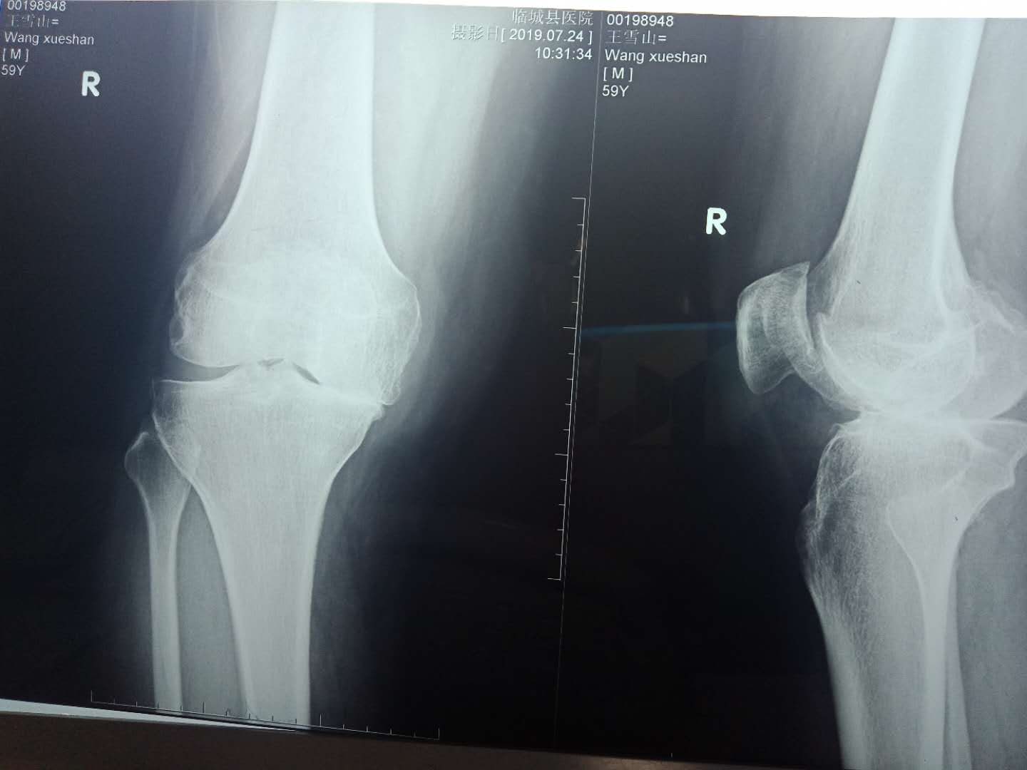 增生性骨关节病,骨质增生症是什么样