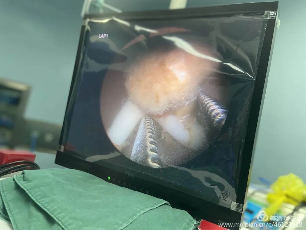 摘除节育环手术,节育环的摘除手术