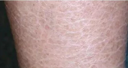 脚后跟鱼鳞状干裂用什么药,小腿后跟干裂起鱼鳞是什么原因