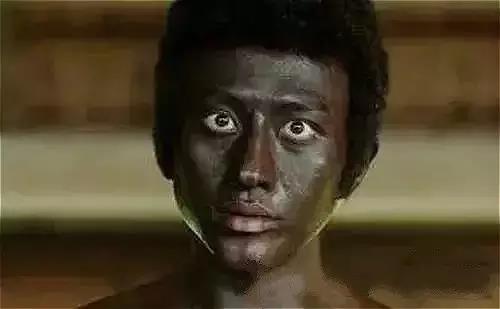 小孩手术疤痕体质怎么除疤,激光除疤适用于疤痕体质吗