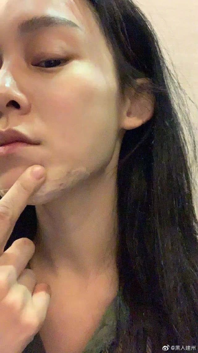 范玮琪深夜摔跤，下巴被摔一个洞，陈建州晒图吓坏网友