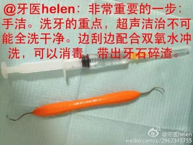 Helen齿科中心——超声波洁牙