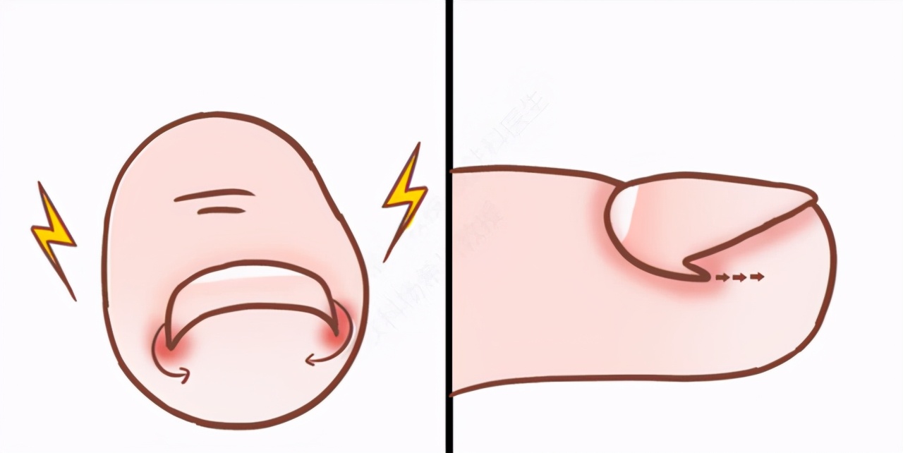 甲沟炎很疼怎么处理,甲沟炎很痛怎么办