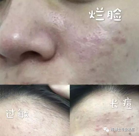 黑头粉刺毛孔粗大螨虫怎么去除,去黑头粉刺螨虫痘痘深层毛孔清洁