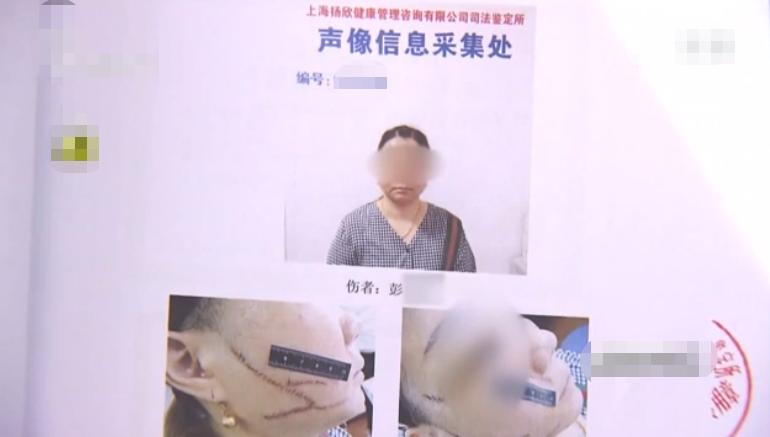 因与两个男人纠缠不清，上海女子被前男友划伤脸部致29厘米长伤疤！事后女子称：前男友真心爱我，会等他出来