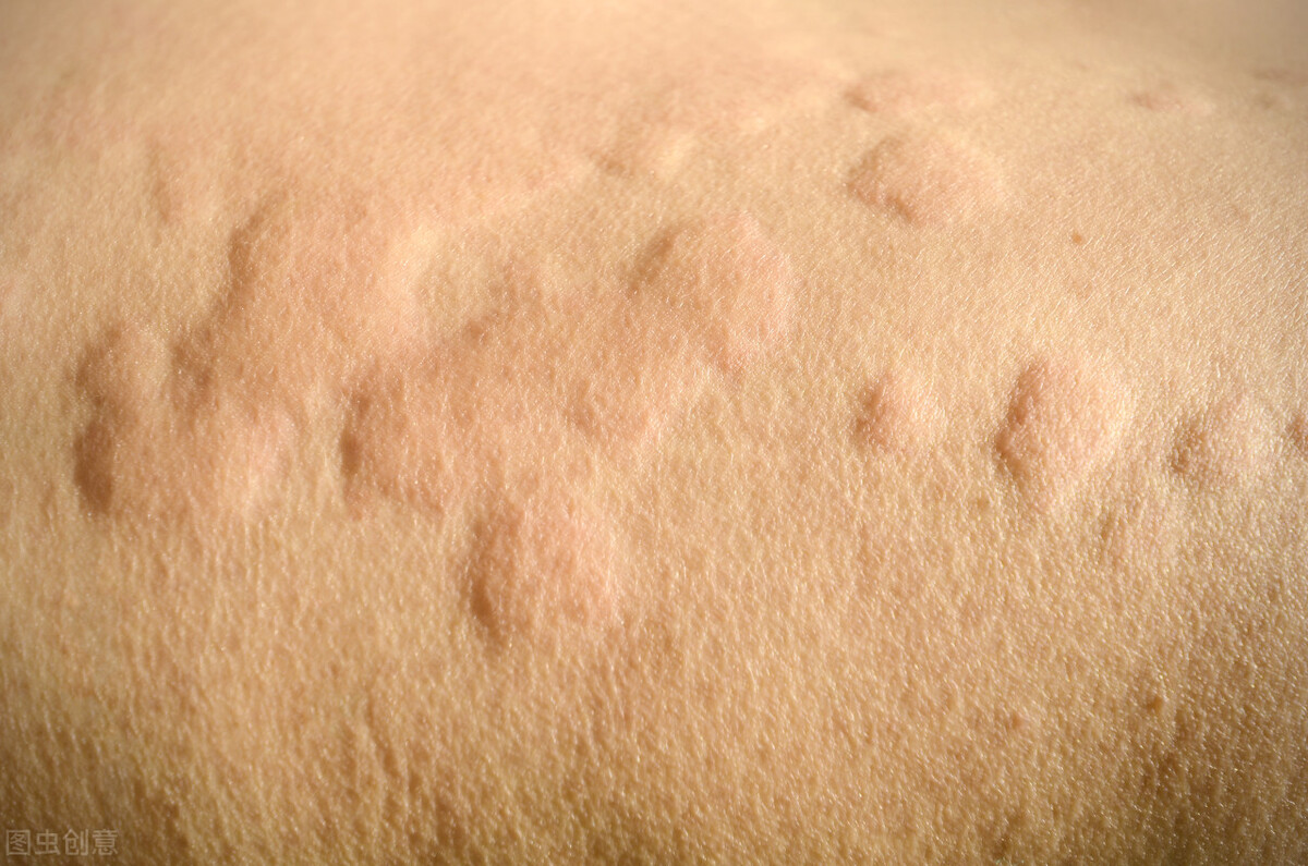 身上突然瘙痒起大疙瘩怎么回事,身上突然起疙瘩瘙痒