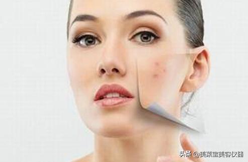 美容祛痘产品怎么用的,美容仪器祛痘