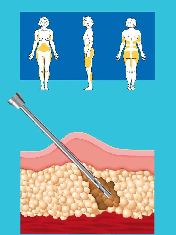 吸脂后出现淤青，应该如何应对？