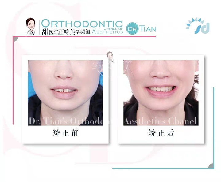 47岁大龄矫正，骨性嘴突+牙缝大+牙周炎｜曹博士正畸复杂病例分享