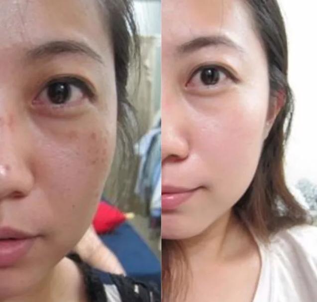 点阵激光祛痘印的副作用和危害,co2点阵激光危害