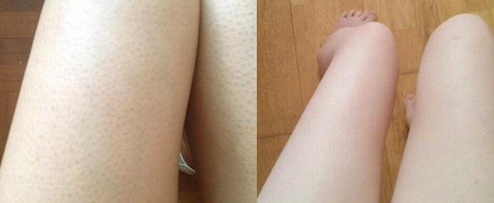 去鸡皮肤的用药步骤,鸡皮肤去除最便宜高效的方法