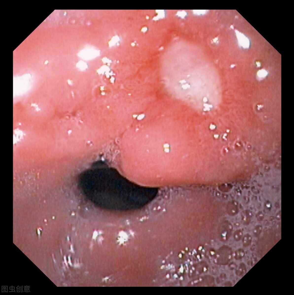 柿子引发的肠梗阻,柿饼为什么会导致肠梗阻
