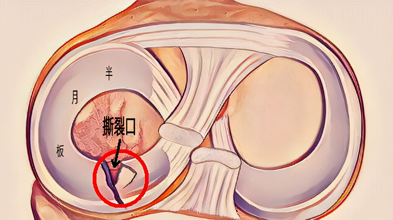半月板有什么保护措施吗,半月板受损需要注意什么