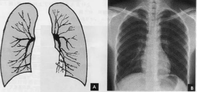 收藏：详细的胸部X线解剖，最基础最实用