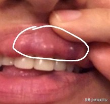 唇部奥美定取出视频全过程,奥美定注射丰唇后的症状