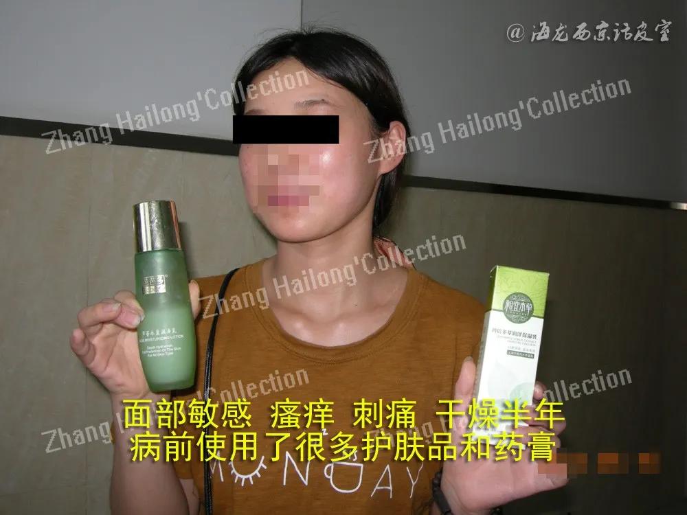 护肤一定要坚持且要有耐心,激素依赖性皮炎怎么护肤