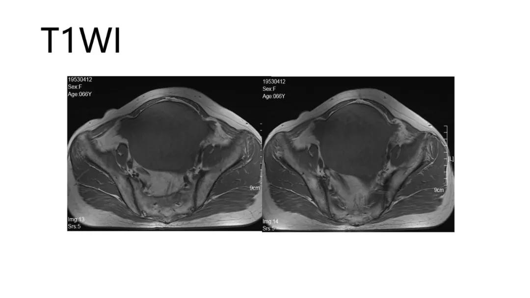 卵巢原发肿瘤的分析思路