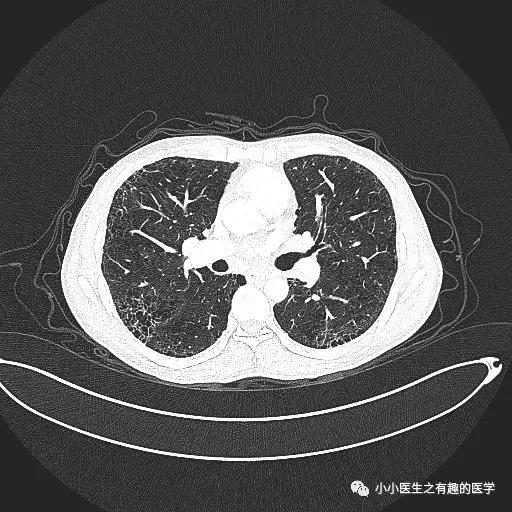 间质性肺炎CT诊断,间质性肺炎ct诊断报告