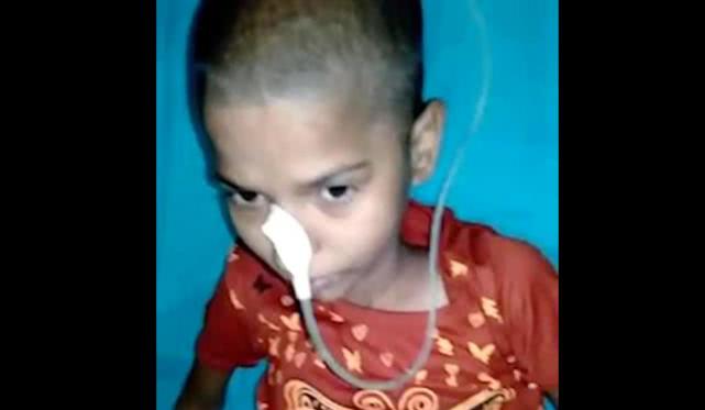 14岁女孩吃头发胃里取出毛球,一女孩胃里取出5斤毛球