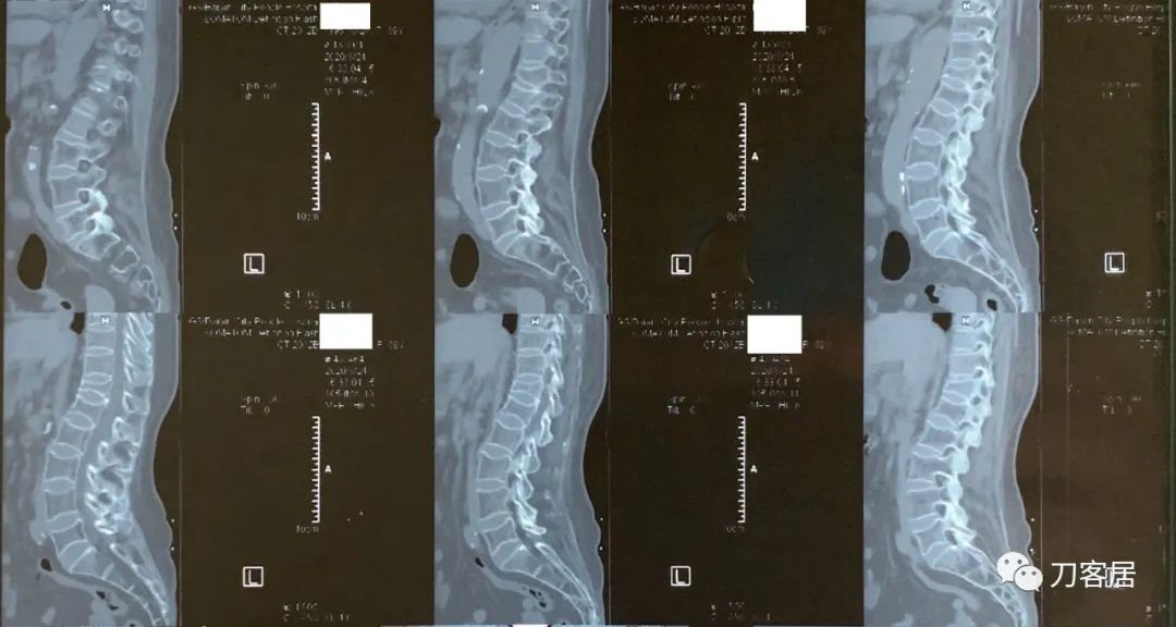 胸椎压缩性骨折病历,脊柱骨质疏松性压缩性骨折