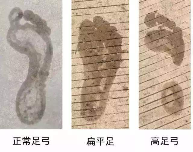足部ct可以看出是不是扁平足吗,孩子脚部知识