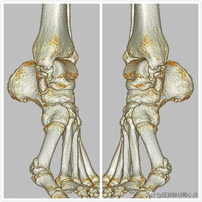 扭伤脚有必要去医院拍片吗,扭伤脚要去哪里看
