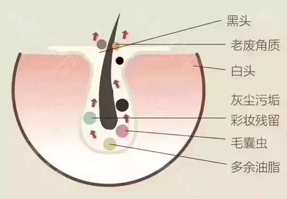 清理黑头的正确方法,黑头清理的简单正确方法