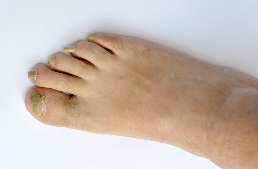 稳定期白斑可以不管吗,初期白斑积极治疗会扩散吗