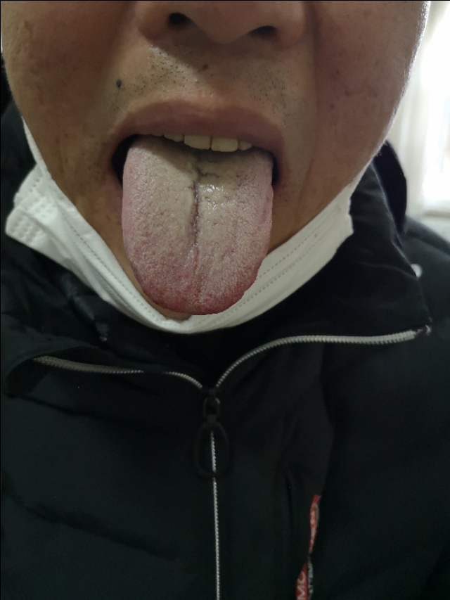 腹部胀满情志焦虑多梦易怒,腹部神经痛焦虑症