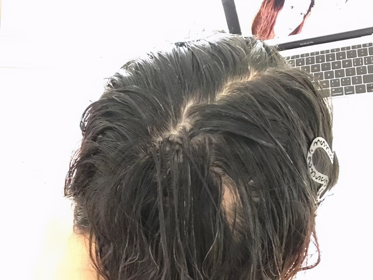 硫磺皂洗头发半年,女子用硫磺洗头坚持一年