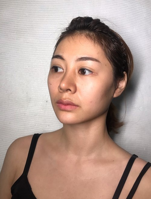 光子嫩肤540,480nm光子嫩肤